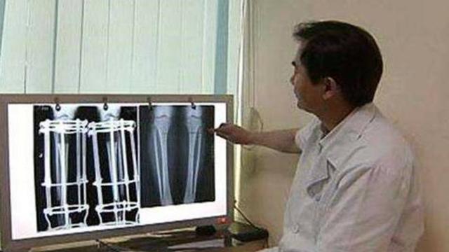 当年花16万断骨，只为增高7.2厘米的李某诺，如今过得怎样了？