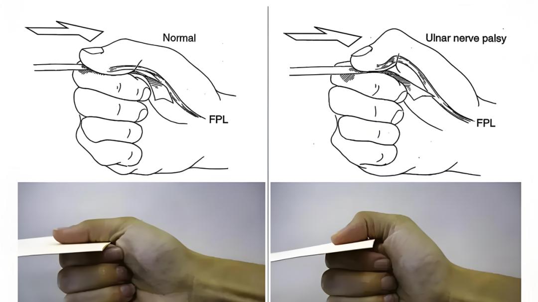 【盘点】上肢常见的 5 个神经卡压综合征