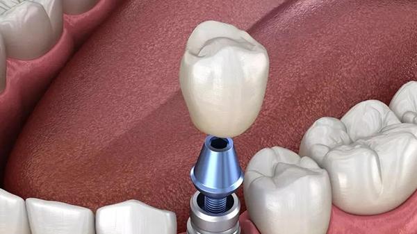 种植牙可以管多少年？年轻人缺牙种牙能用多久？—义乌口腔种植