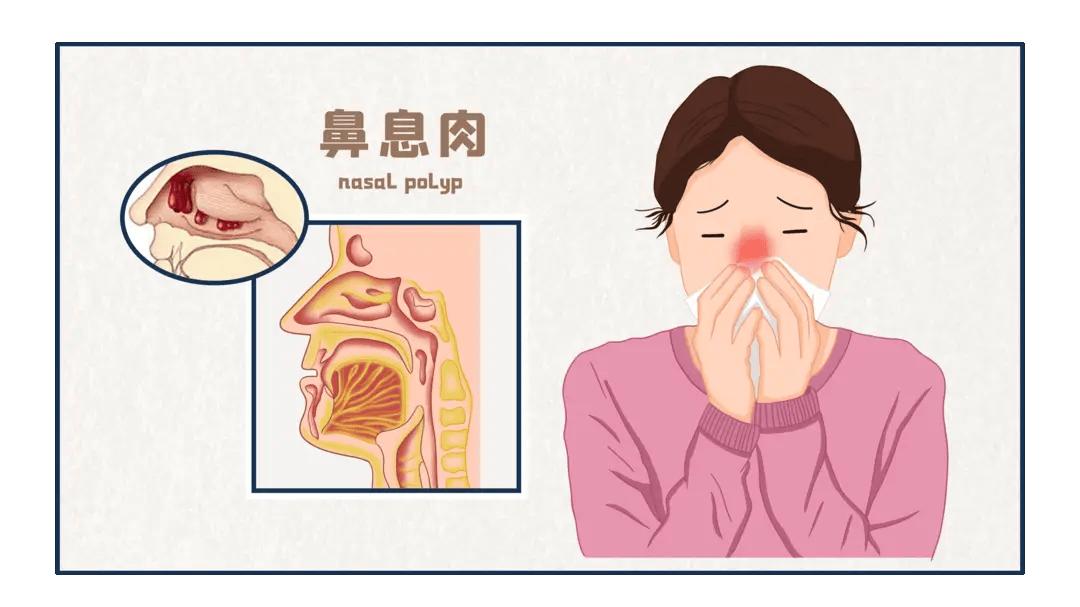 鼻息肉的症状与潜在危害：不可小觑的鼻腔问题！