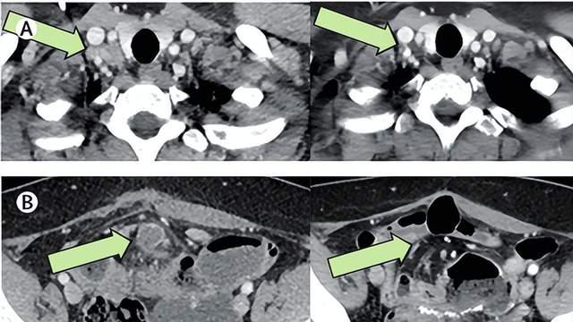 癌症治疗又一“王炸”！TIL疗法正式登场：面对肺癌、宫颈癌、黑色素瘤，缓解时间超36个月