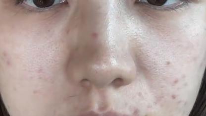 淡化黑色痘印用什么泥膜比较好 专治顽固性痘印，12 天还你干净肌肤