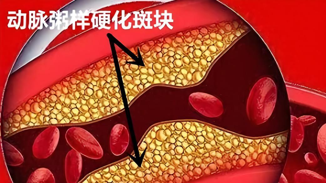 你的血管正在生锈，小心动脉粥样硬化一旦发作，可能引发心梗脑梗