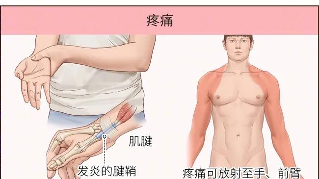 得了腱鞘炎别慌！牢记这 6 个科学要点，疼痛轻松消退