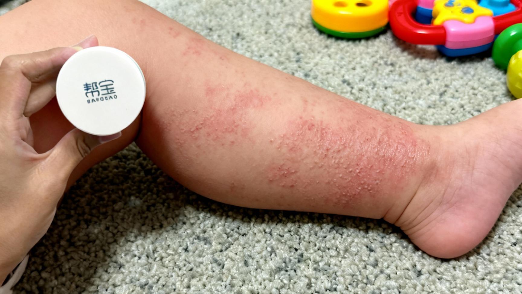 【帮宝抑菌膏】宝宝口水湿疹怎么办？宝妈必看护理与预防全攻略