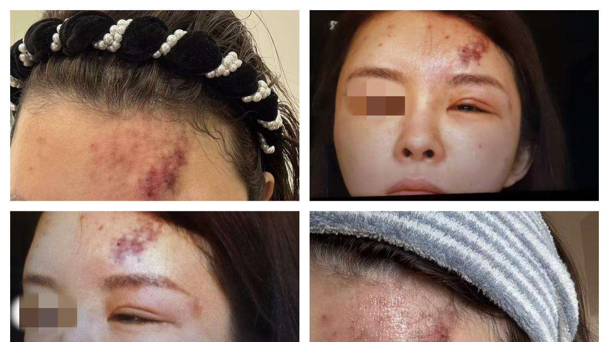 医美注射致血管栓塞、脑梗、毁容，消费者控诉院方延误救治拒担责