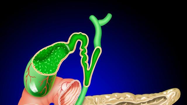 体检查出胆囊息肉？别瞎忌口、别乱切除！大部分根本不用慌