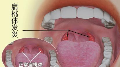总被扁桃体炎缠上？扁桃体频发炎的几个原因