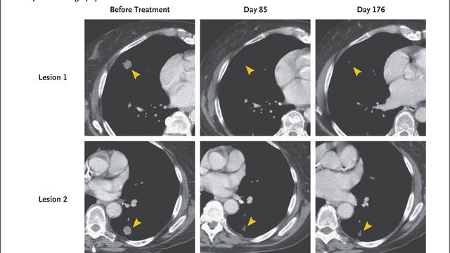 细胞免疫疗法双雄：血癌“克星”CAR-T疗法与实体瘤新锐TCR-T疗法