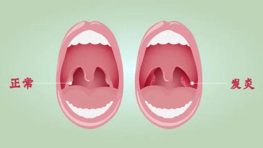 扁桃体到底切不切，听听医生怎么说