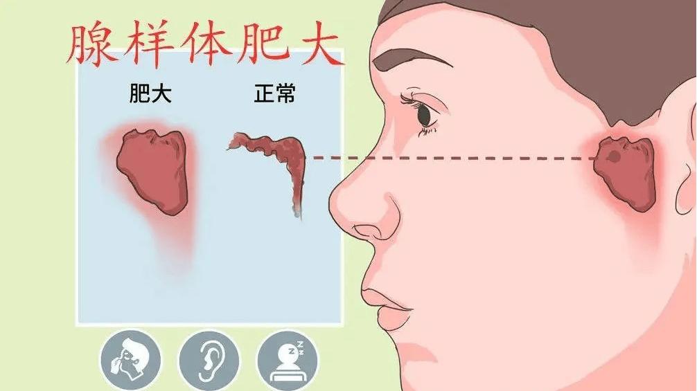 孩子腺样体肥大，到底要不要切？听听耳鼻喉医院医生怎么说
