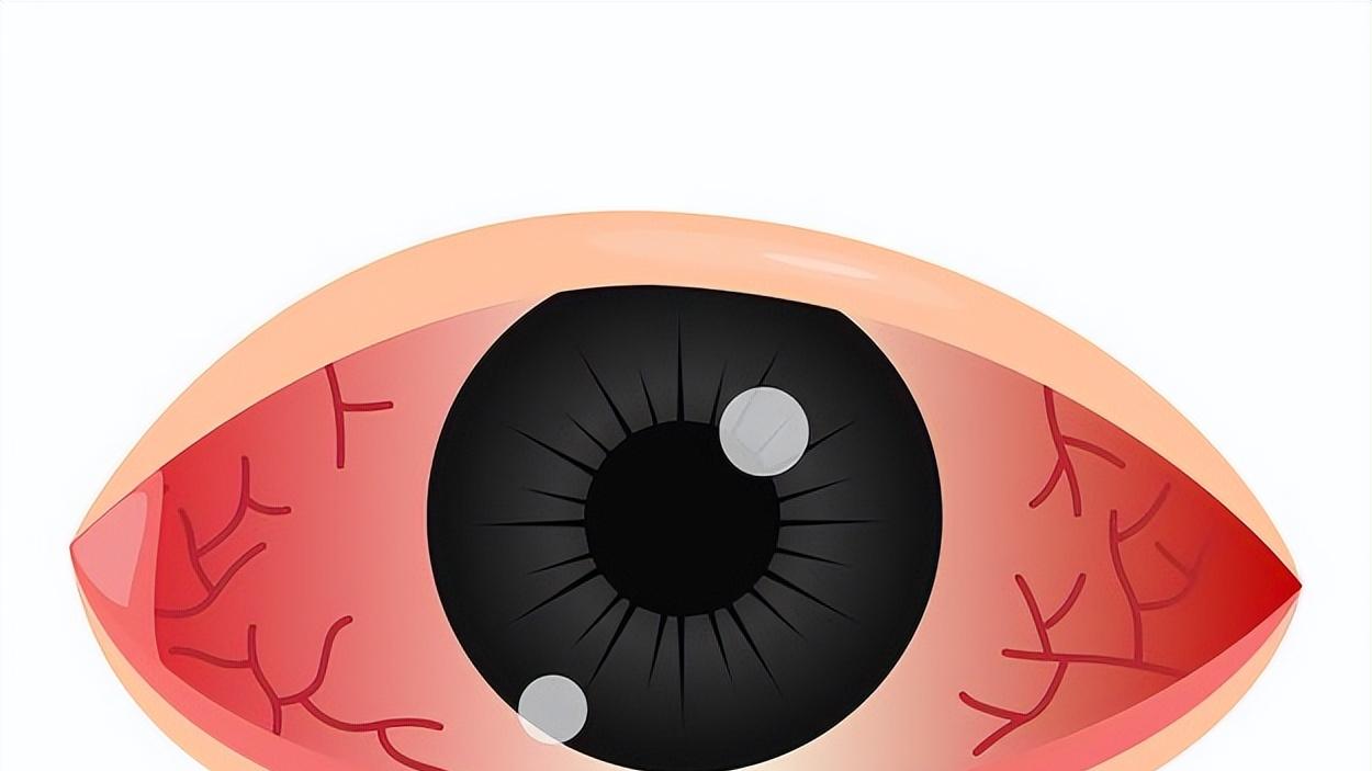 眼睛红肿痒痛？当心结膜炎作怪，3大元凶最容易患病