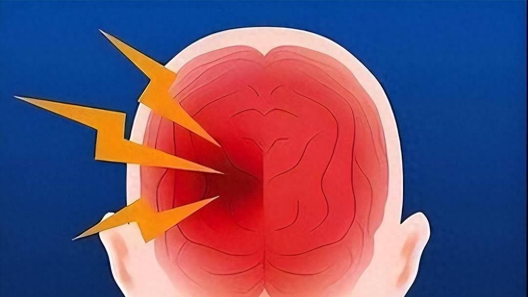 当你的大脑在流血，每一秒都关乎生死，出现4类症状，小心脑出血