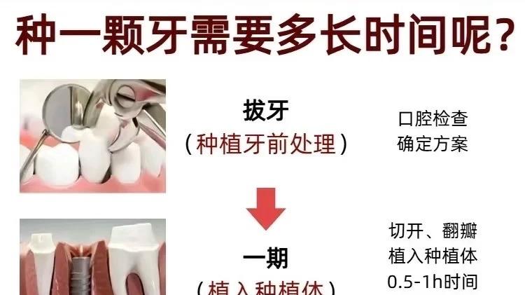 种一颗种植牙需要多久？