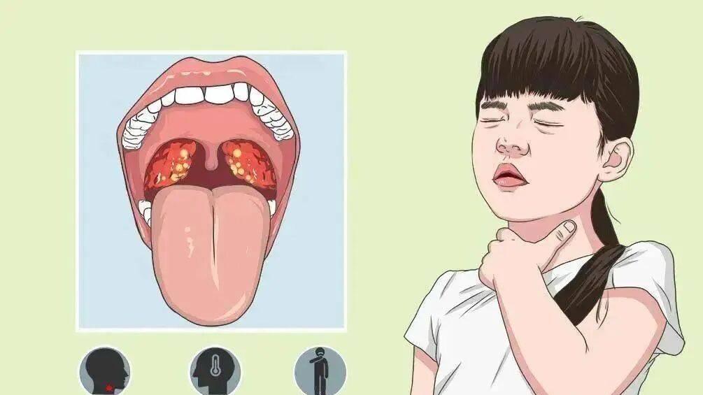 嗓子肿痛反复“找上门”？扁桃体炎的真相与科学应对