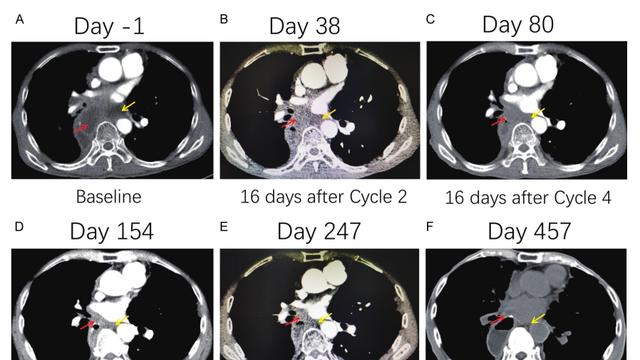 国内外癌症疫苗研发加速！癌症疫苗真的能防复发吗？多项临床数据出炉，带来这些积极信号