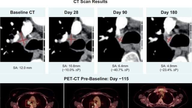 面对实体瘤这座“堡垒”，CAR-T终于亮剑！胃癌、肝癌、肺癌接连告捷，《自然》研究：我们找到了新的“