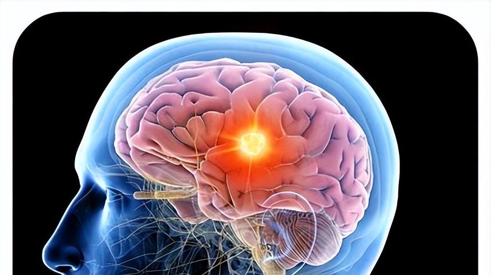 脑膜炎24小时内可致命，4类信号别忽视，早期接种疫苗是关键