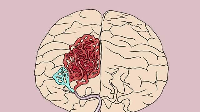 正在工作，突然头晕、眼前发黑，脑供血不足在作怪，预防做好5点