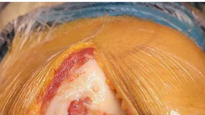 关节疼痛反复发作的根源：关节撞击