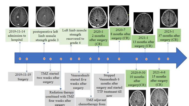 34个月稳定生活：脑瘤治疗迎来新突破，电场治疗实现长期生存，国产设备已上市