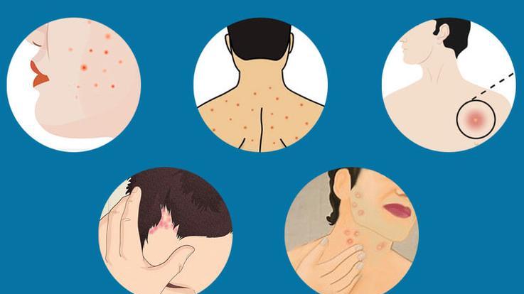 头上突如其来的红疙瘩？毛囊炎在作怪，别等脱发、感染才后悔