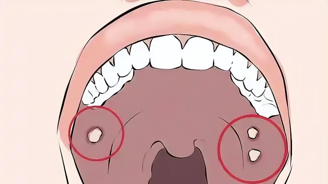 嘴里小伤口超过2周不愈合？别不当回事，小心口腔癌在敲门