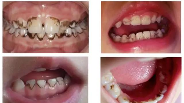 宝宝牙齿发黑像蛀牙？别慌！这3种“假性蛀牙”家长必懂