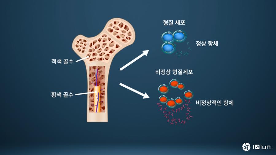 新药让多发性骨髓瘤患者十年生存成为可能