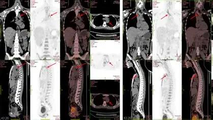 乌帕替尼的真实效果怎么样，史上最详细解读