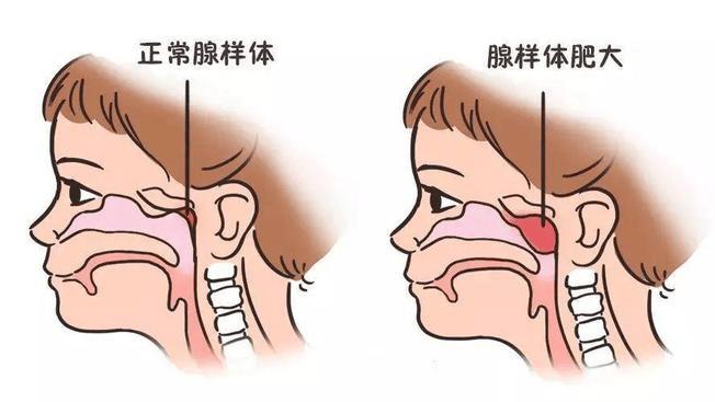 孩子越长越“丑”？当心是腺样体面容在“作祟”