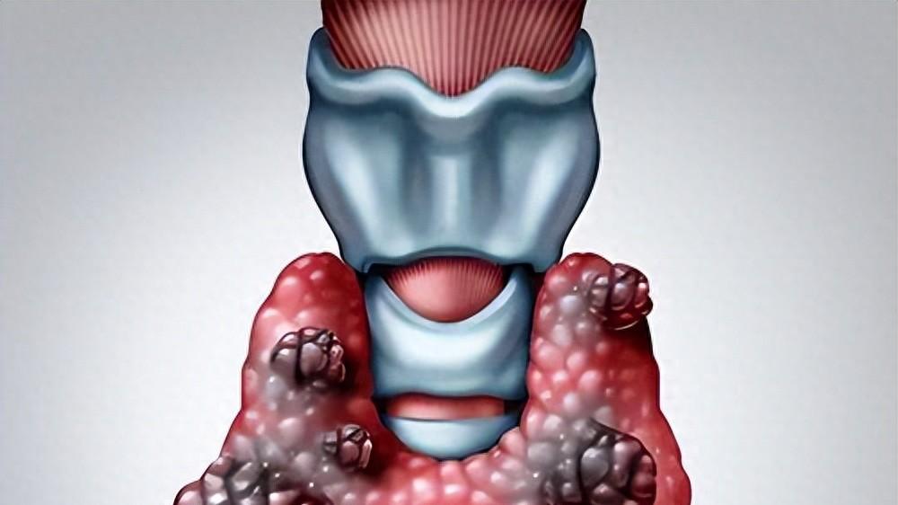 体检查出甲状腺结节？会不会癌变？别慌大多数是良性，记住这3步