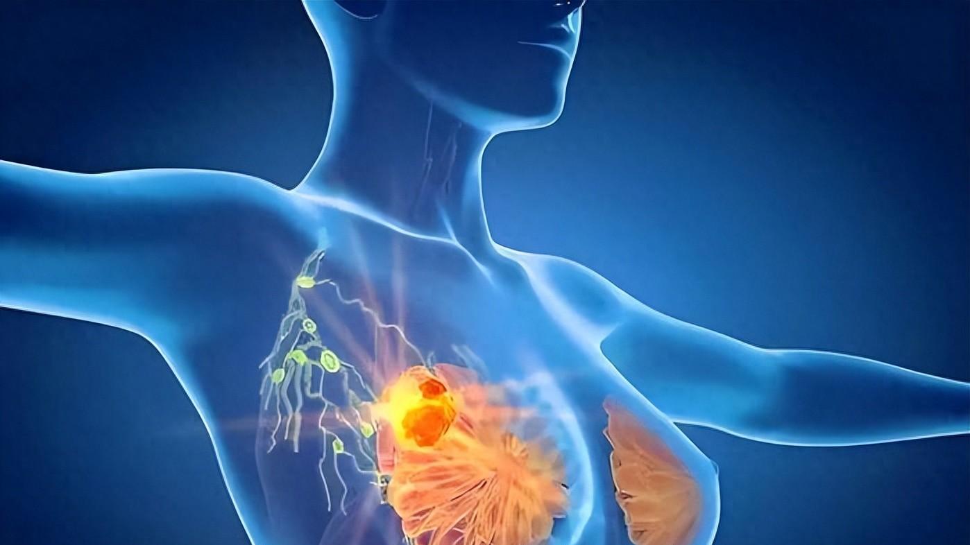 早期乳腺癌生存率可达90%以上，5个求救信号别忽视，早发现早治疗