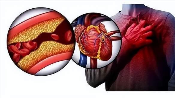 动脉硬化不是老毛病，90%的患者可以逆转，早期预防做好6点