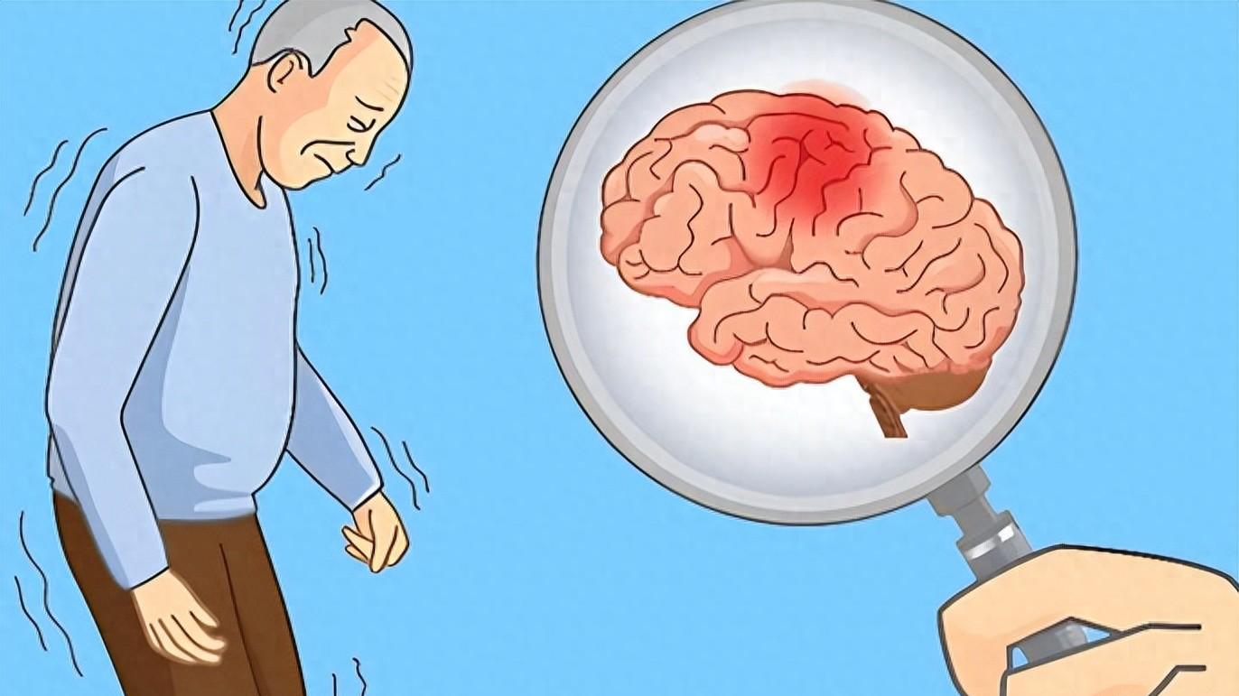 小中风别不当回事，抓住6个预警能救命，别等瘫痪才后悔