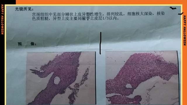 这个病例是2015年确诊我治愈的一个宫颈癌的病例