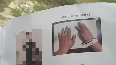 四川刘贤务工十余年致残陷维权困局：协议存争议，赔偿难落实