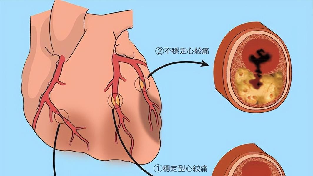 心绞痛，西医这样治，稳心又安全——拒绝盲目吃药