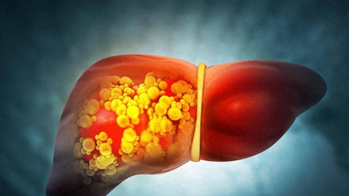 偶尔喝点没关系？酒精肝早期几乎没症状！隐形期长达5-10年