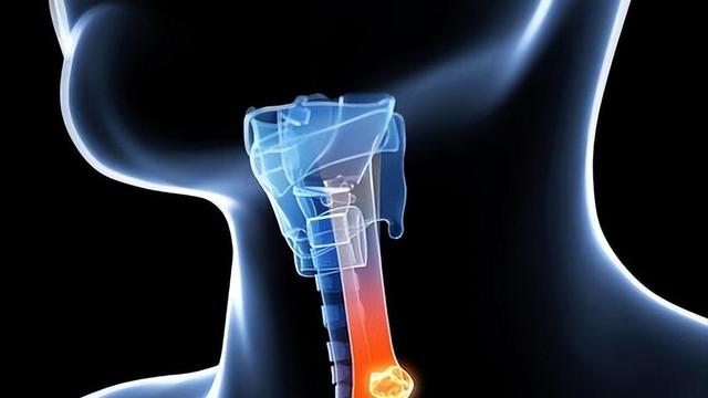 吞咽时总有东西卡住？别大意小心食管癌，早期发现生存率80%以上
