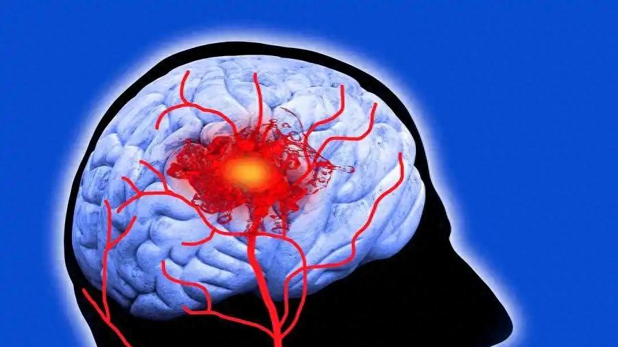 急性脑梗塞，每分钟都在倒计时，30秒学会4个救命信号