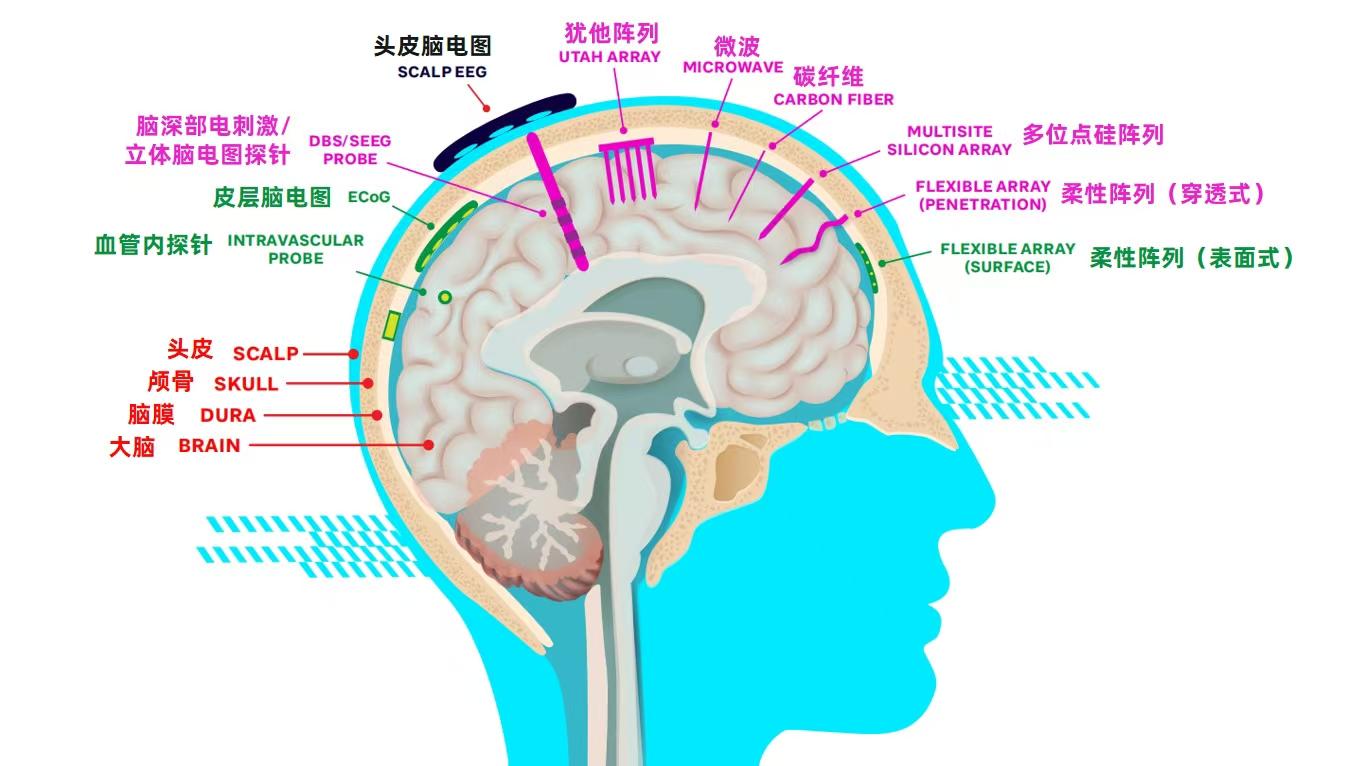 脑机接口的中美竞速：谁在定义人机共生的未来？
