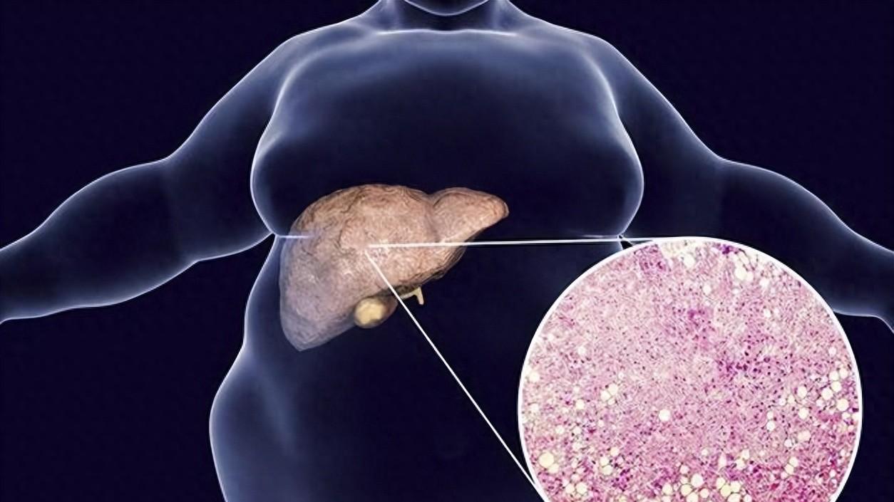 脂肪肝≠胖子专属，越来越年轻化，5个习惯易患病，4个误区别踩