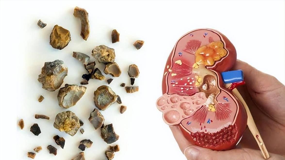 别把肾结石当成老年病，5类习惯最容易患病，早期做好这2点预防
