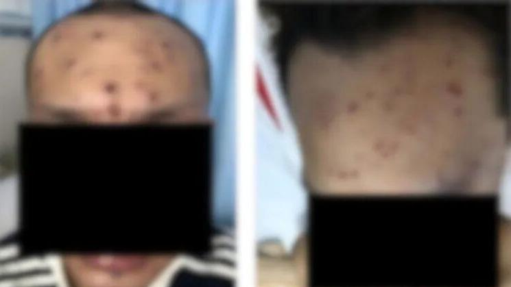 警惕！广西23岁HIV感染者感染猴痘后死亡，专家提醒：CD4水平是生死线