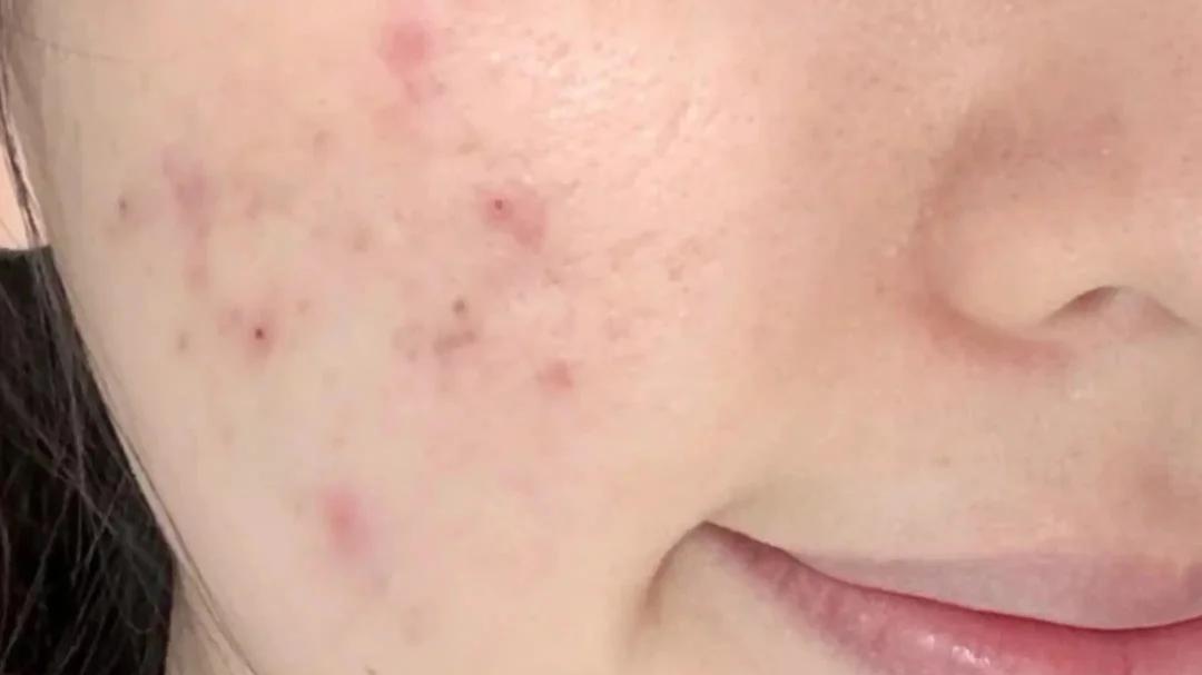 祛痘以及深度清洁用什么清除 顽固性痘痘救星！12 天让皮肤恢复光滑