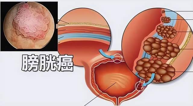 小便带血不痛不痒？不是上火，膀胱癌最会伪装，90%误诊拖成晚期