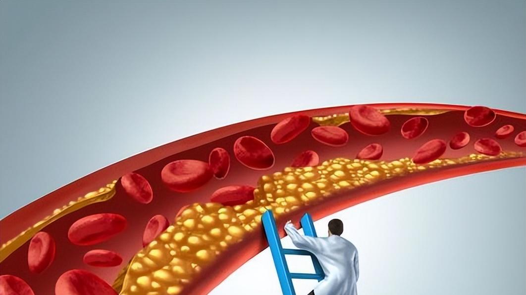 平时不胖，饮食也清淡，怎么血脂超标？3个习惯加速你的血管堵塞