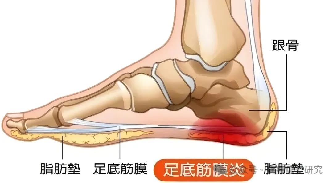 晨起足跟痛？3分钟分清足底筋膜炎与跟腱炎