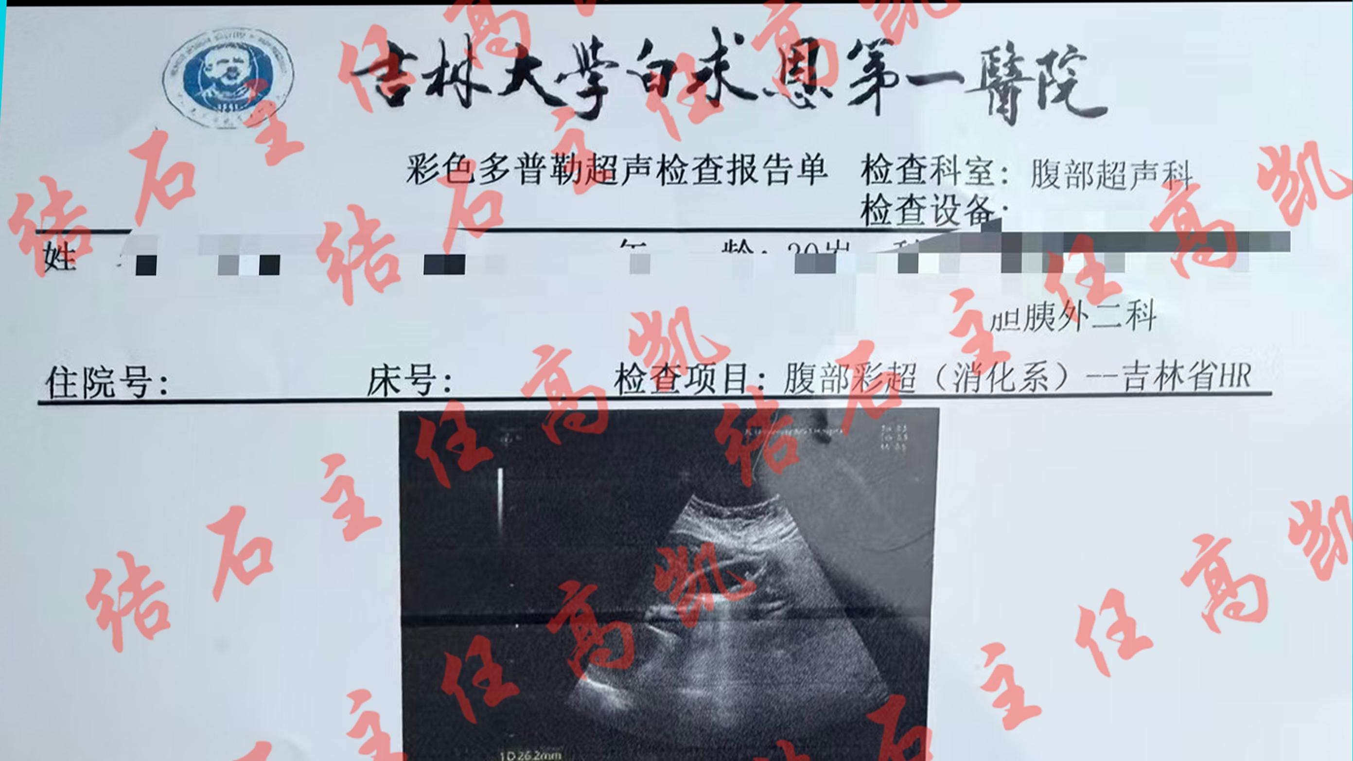 泥沙样结石26X8毫米3个月后反馈结石排出